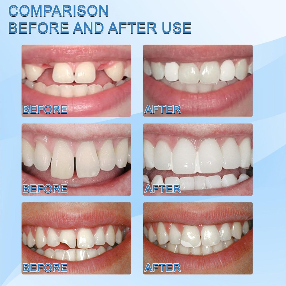 『BUY 1 TAKE 1』30ML Temporary Tooth Repair Kit Teeth and Gaps Moldable ...