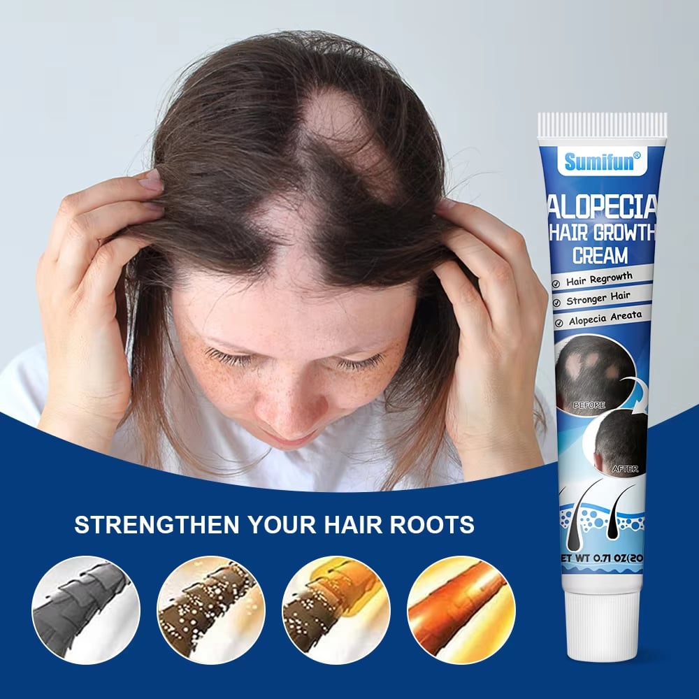 Alopecia Hair Growth Cream Pampakapal ng Buhok | Bald Spot, Hair Fall ...