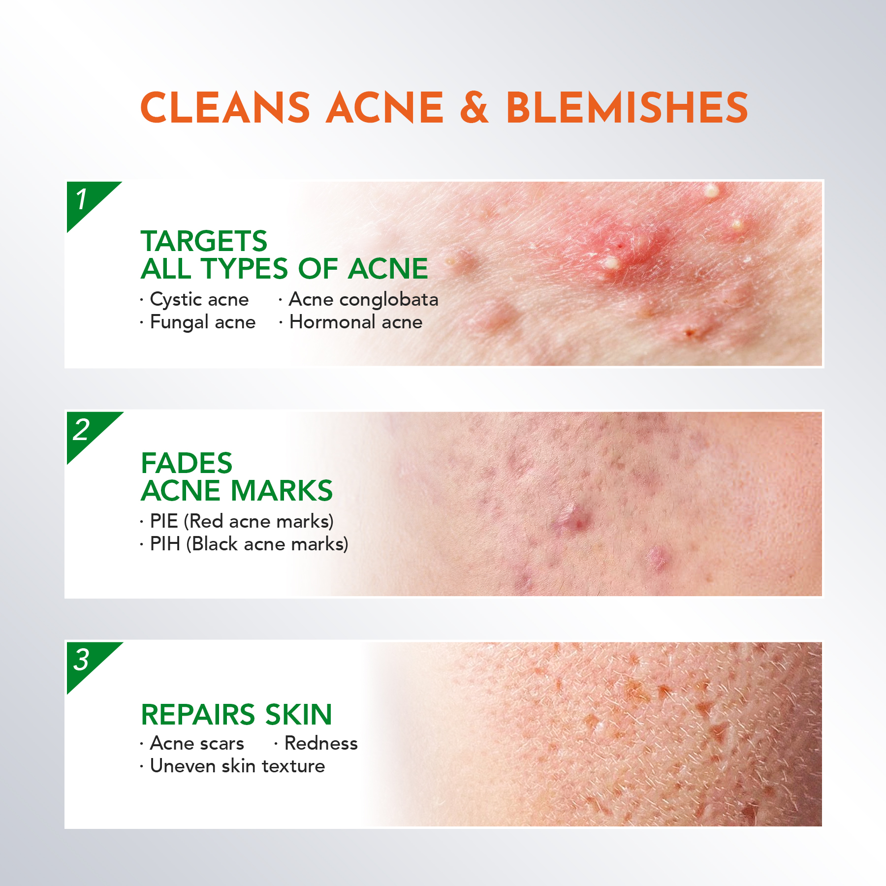 [Complete Acne and Barrier Care] AcnePlus 3 in 1 Set - Cleansing Gel ...