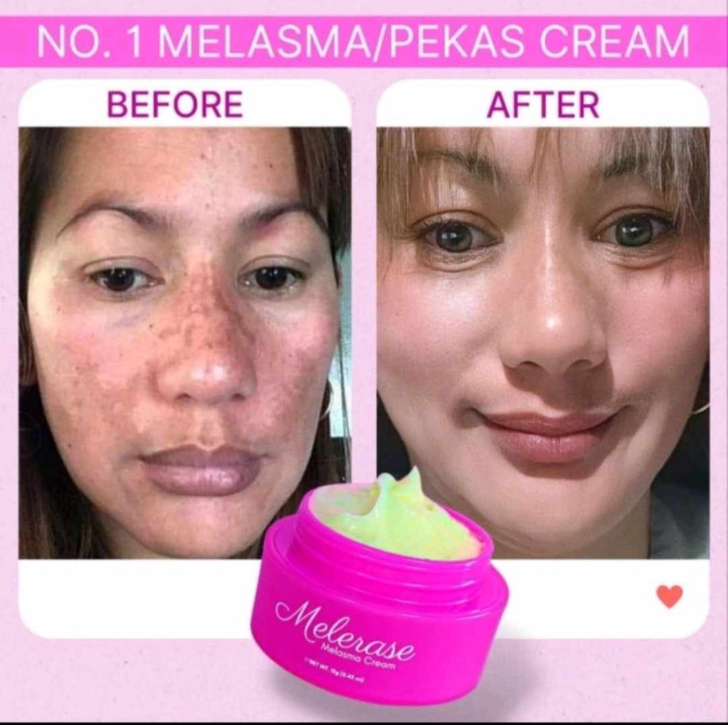Belle Glow Melasma Duo new packaging - Mela-rase facial cream & Premium ...