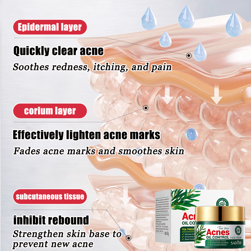 TEA TREE 50g acne removal oil control pimples pangtanggal ng pimples ...