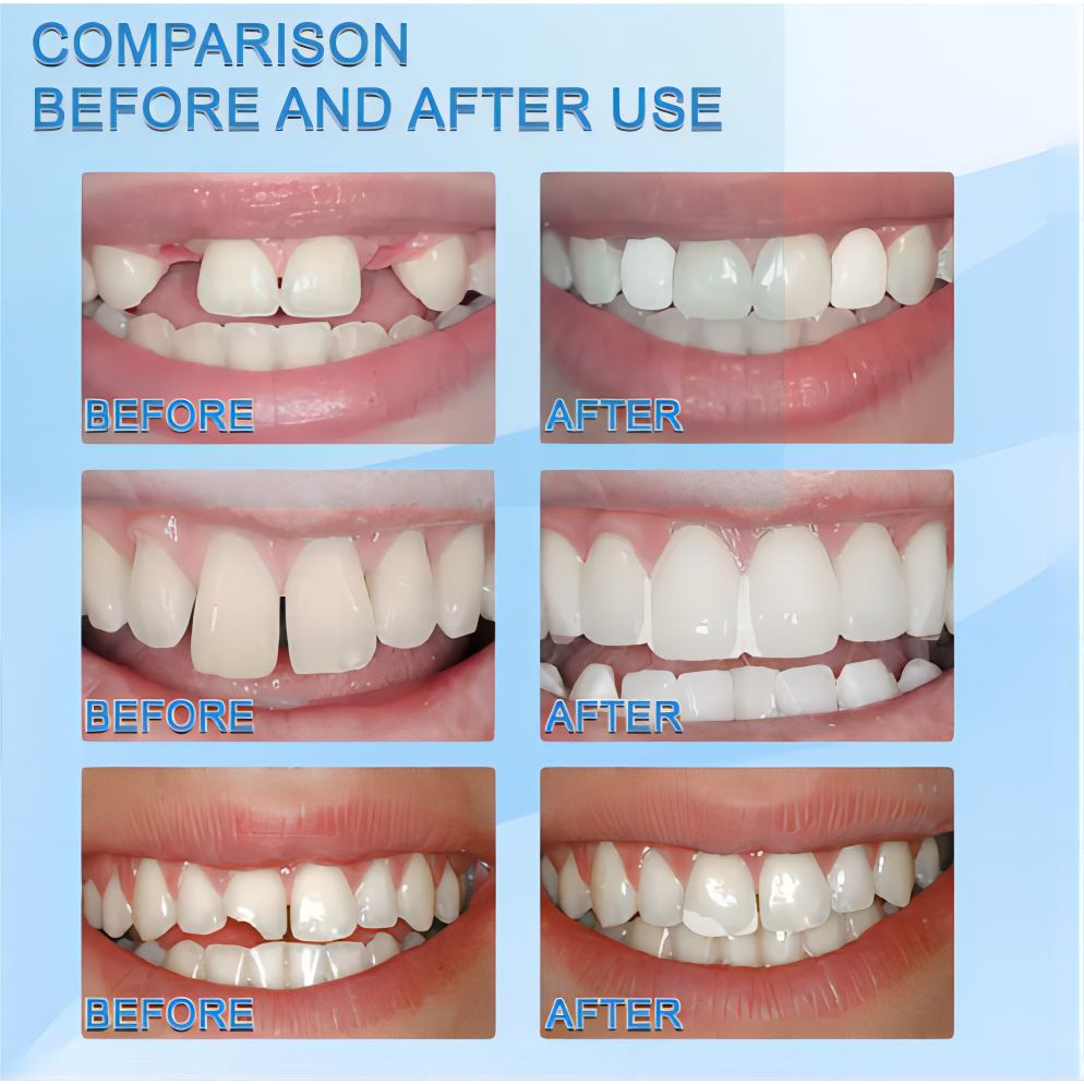 【Buy 1 Take 1】Tooth Repair Kit For Temporary Tooth Filling Visual ...