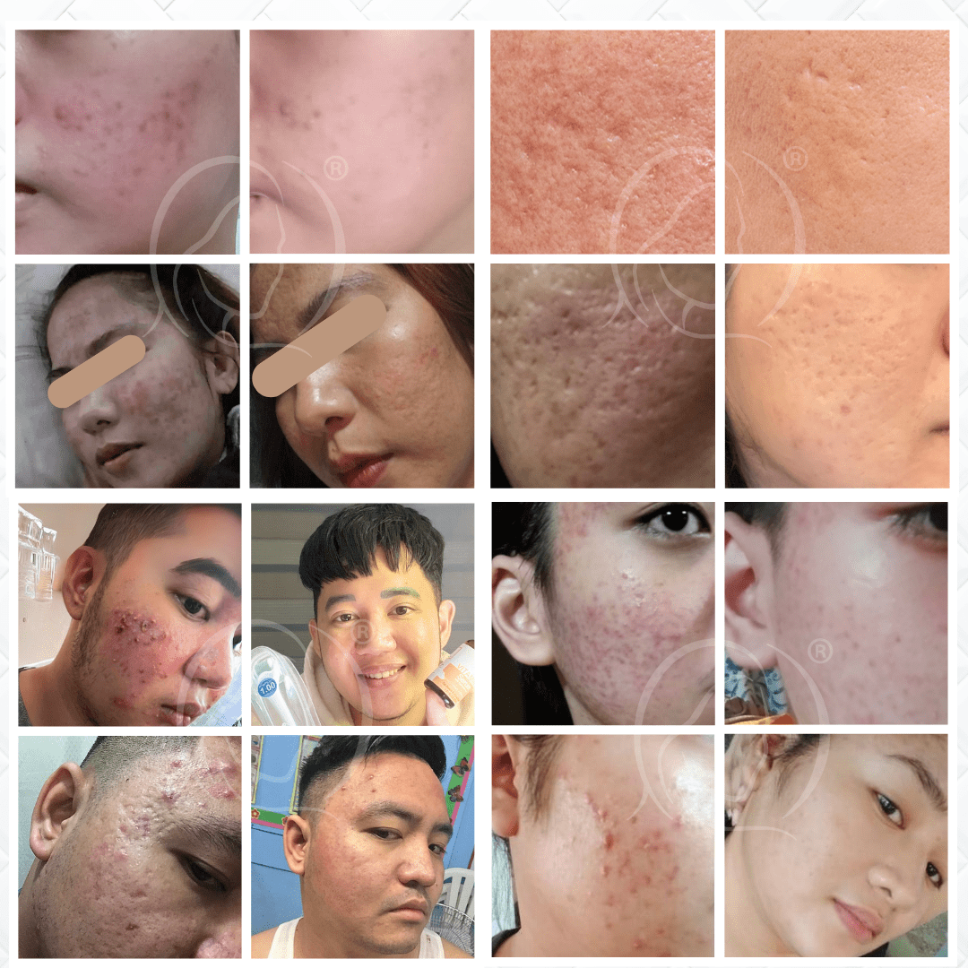 [PROMO] PACKAGE A by Derma Roller Philippines (REPAIR PACKAGE) | Shopee ...