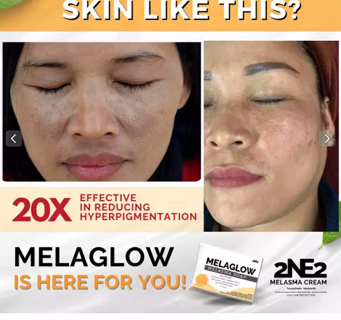 Thailand MelaGlow Melasma Soap w/ Tea Tree Oil (100g) - Melasma, Pekas ...
