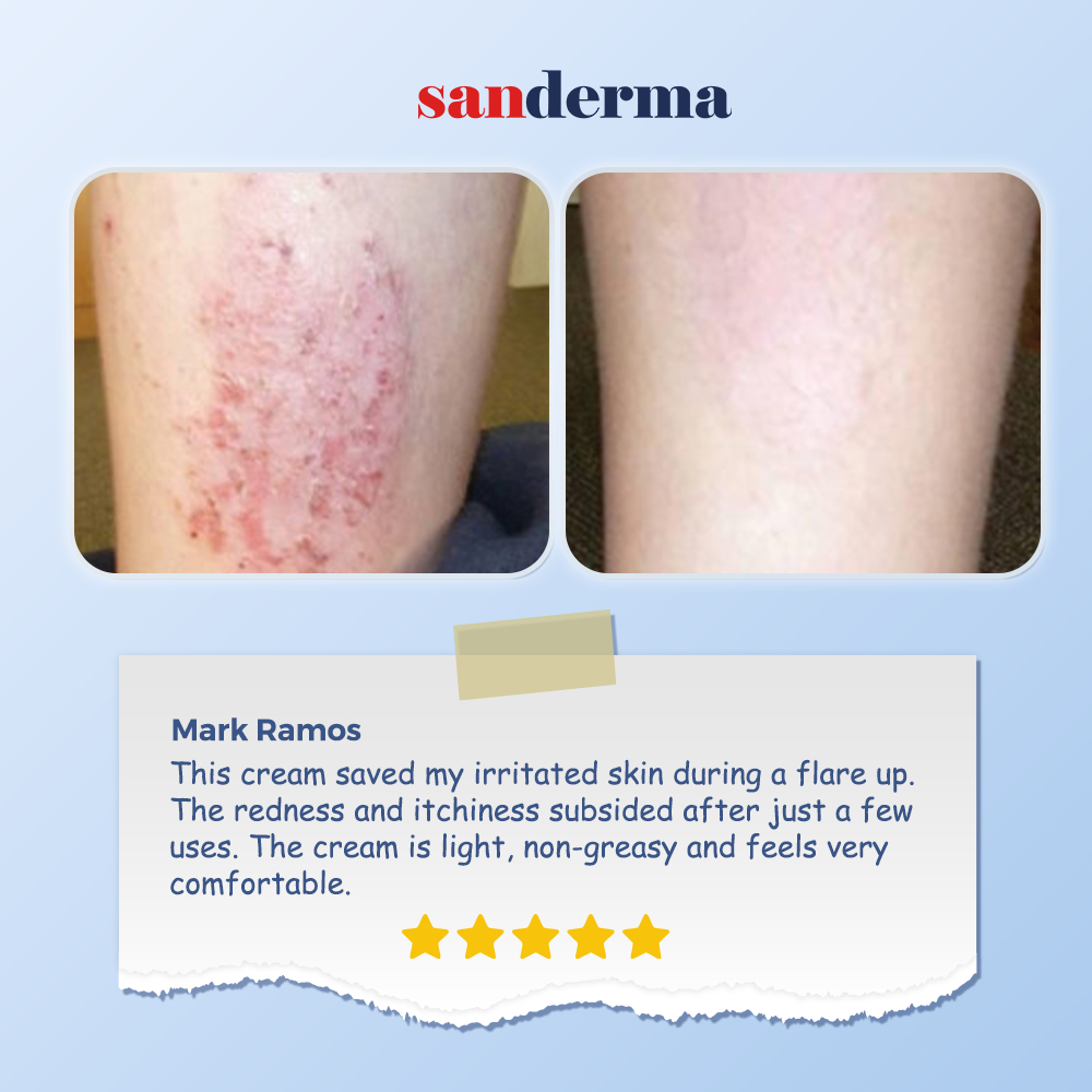 Sanderma Total Skin Care Routine – Soap + Serum + Cream | 3-Step Daily ...