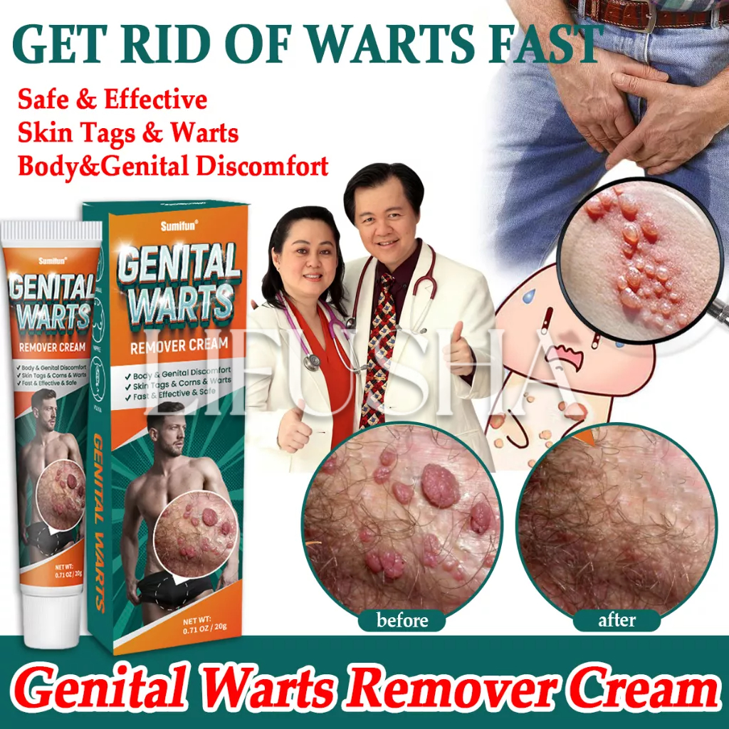 Genital Warts Remover Cream Herpes Genital Condyloma Skin Tag Remover