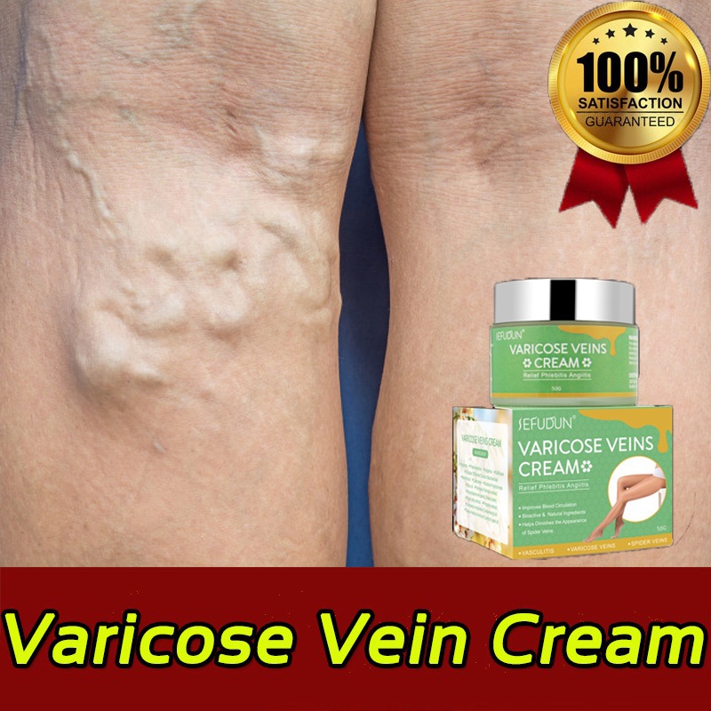 SEFUDUN Varicose Vein Cream Varicose Vein Treatment Cream Effective ...