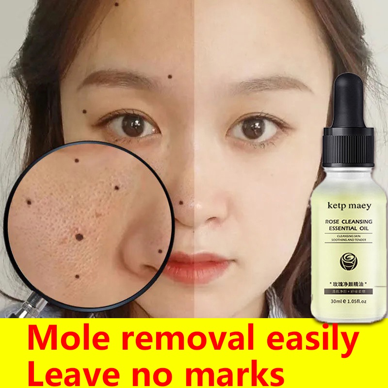 ?100 Effective Mole Remover Mole Removal Potion Mole Removal Cream