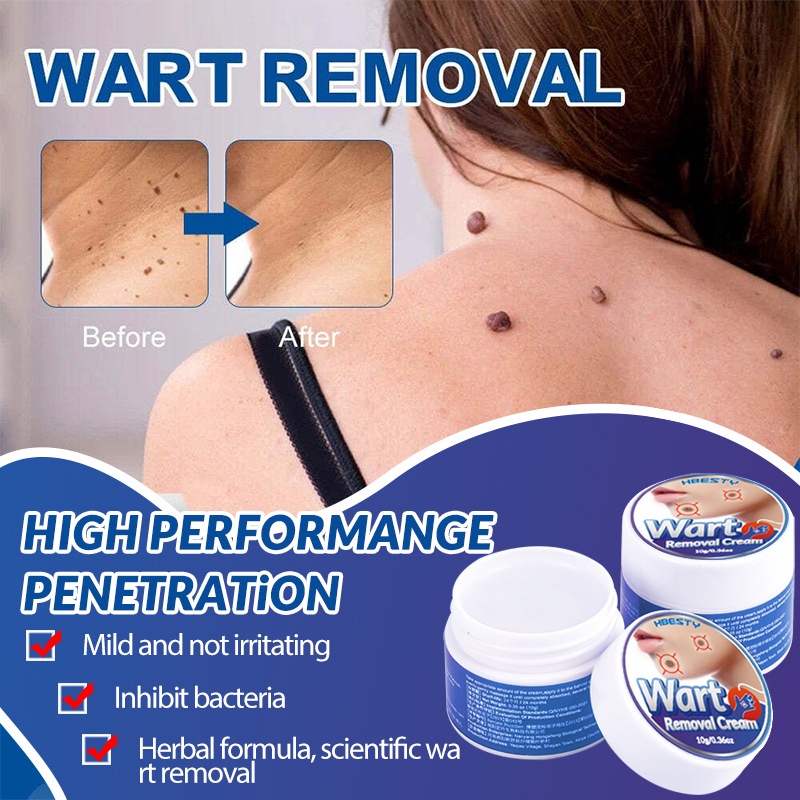 Wart Remover Cream Skin Tag Remover Ointment Against Condyloma ...