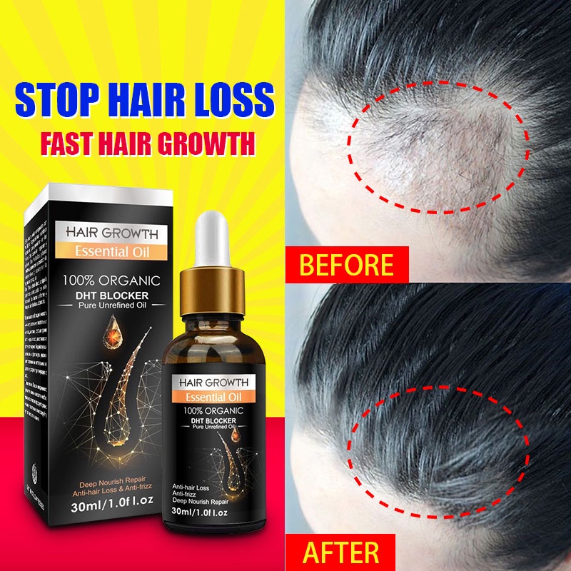 Hair grower for deals men