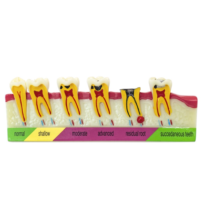 Teeth Caries Classify Tooth Model of Pathological Process Around Teeth