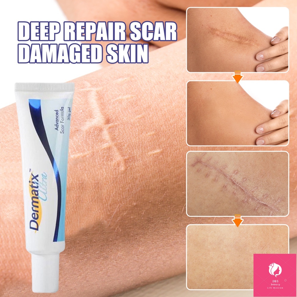 contractubex scar gel original Australia Dermatix Scar Gel Acne Scars ...