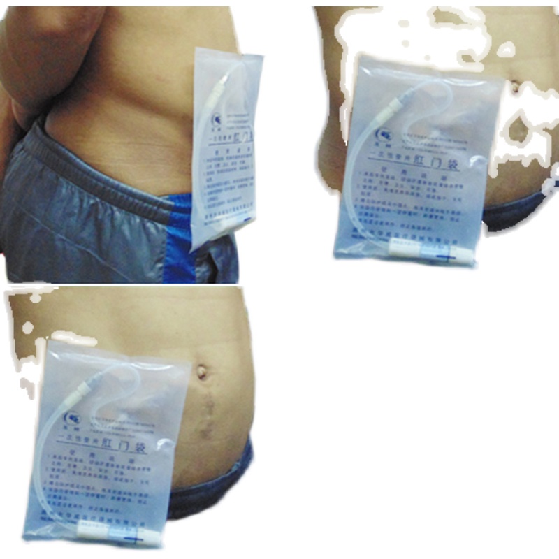 Disposable use anal bag stoma bag paste stool anal ostomy bag peritoneal dialysis peritoneal