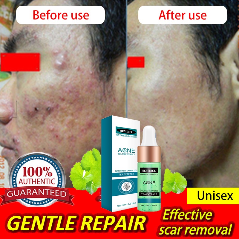 HEMEIEL Tea Tree Acne Remover Acne Treatment Serum/Acne and Pimple