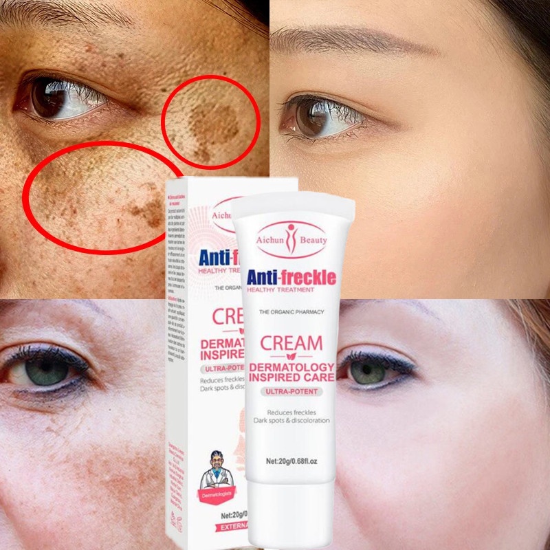 ﹍Effective Freckle Cream Remove Dark Spots Witening Cream Fade Acne ...