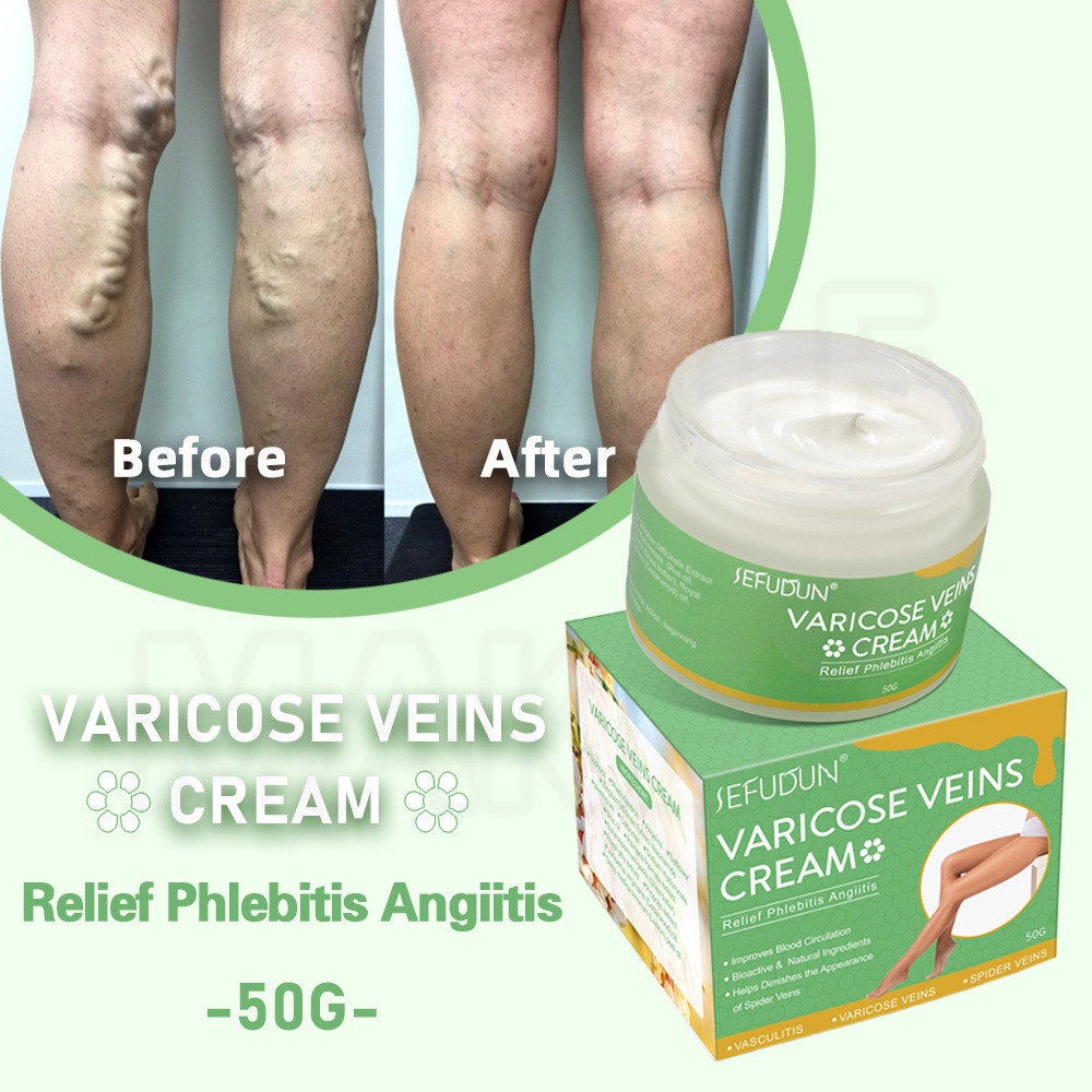 SEFUDUN Varicose Vein Cream Varicose Vein Treatment Cream Effective