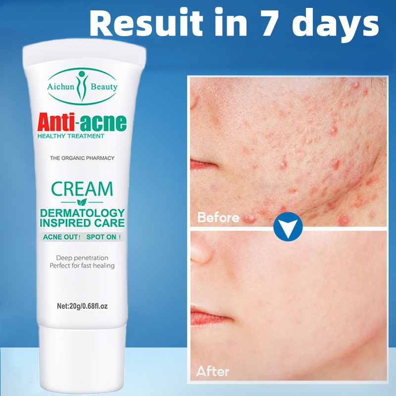 Anti Pimple And Acne Remover Cream SOS Scar Pimples Eraser Quickfx