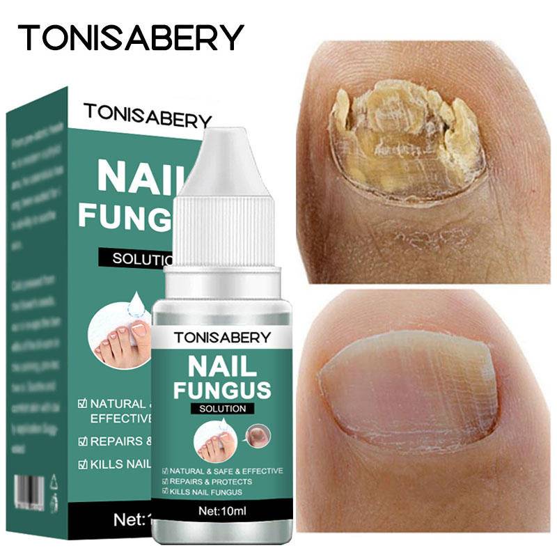 TONISABERY Ori Brand Nail Fungus Treatment Feet Care Products Essence
