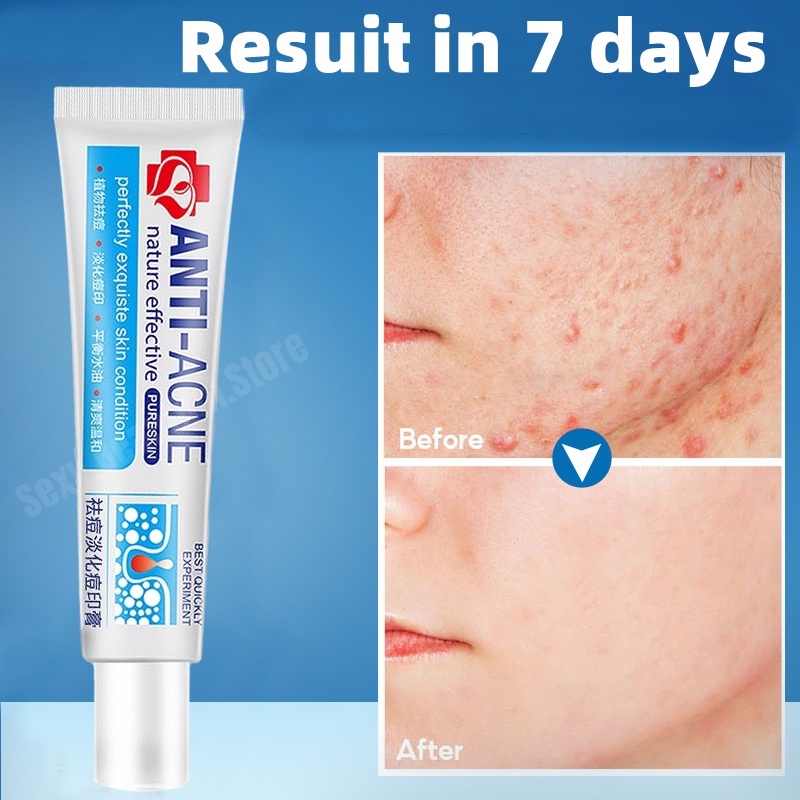 100 effective Remover Acne Cream Fades Acne Marks Repairs Acne Pits