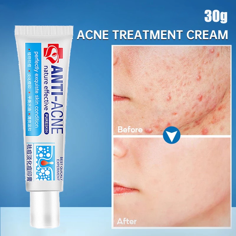 Acne cream pimple scar removal Cream Whitening Moisturizing Skin Care