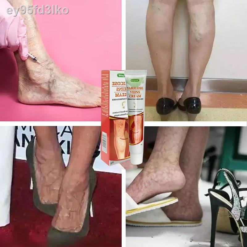 (cod)Varicose veins Vasculitis Treatment Cream relieve swelling pain