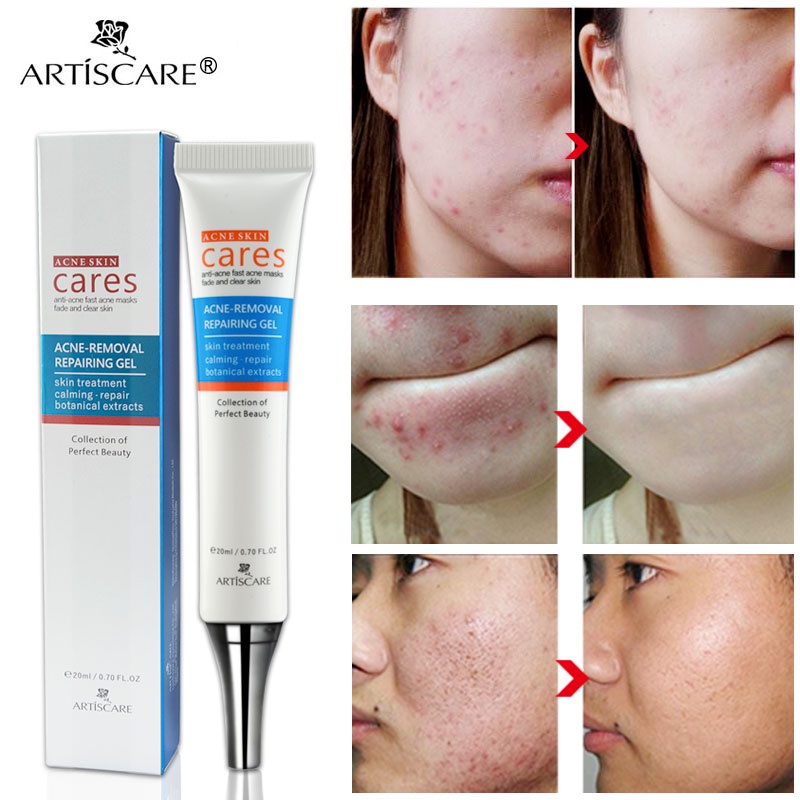 ARTISCARE Pimple Remover Cream Acne Marks Remover Cream Skin Care