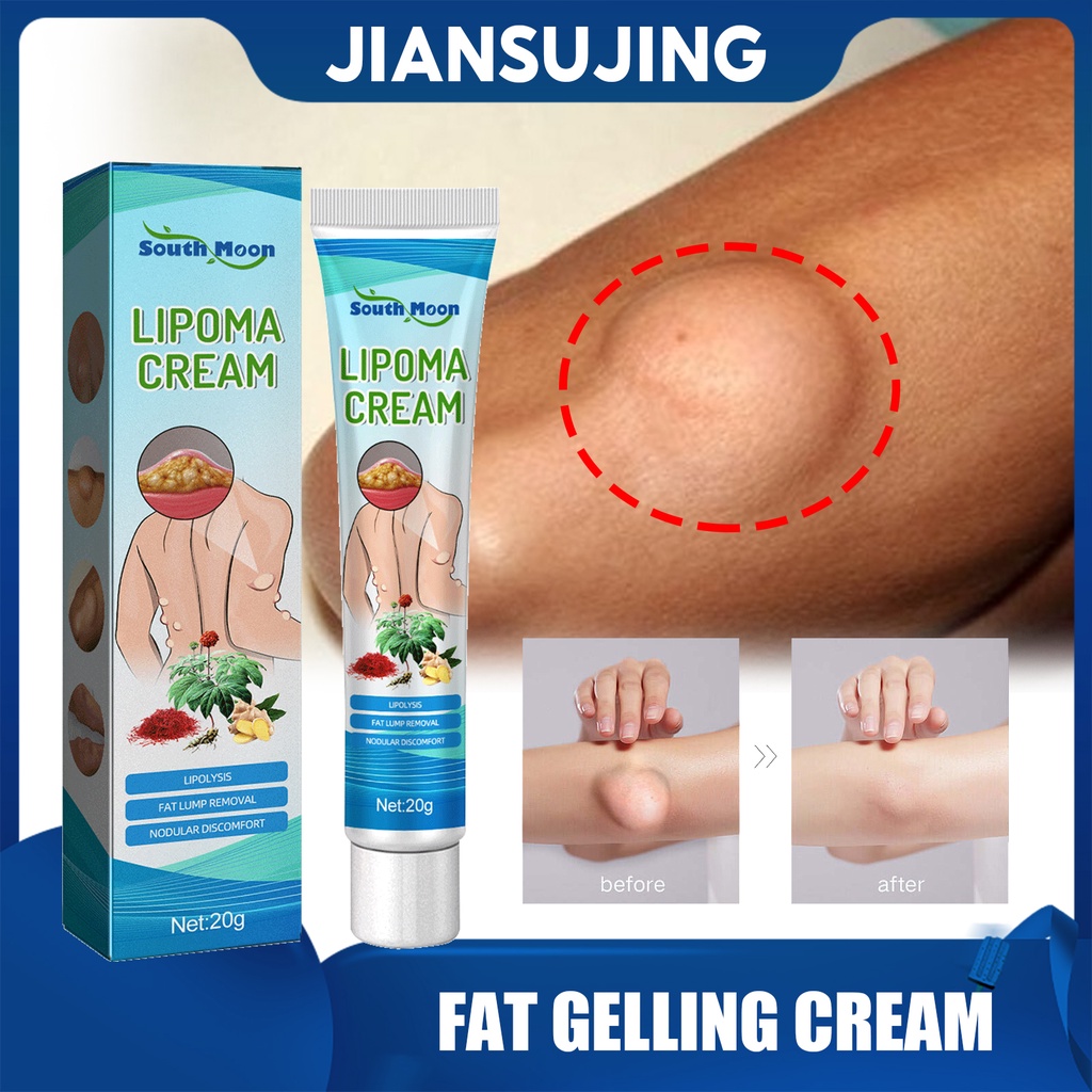 South Moon Lipoma Removal Cream Natural Herbal Fat Lump Removal Lipoma Ointment Gentle Anti 