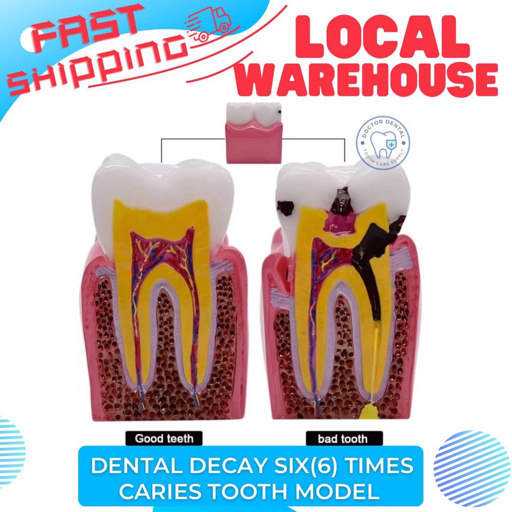 Teeth Comparison Model Dental Decay Six (6) Times Caries Tooth Teaching ...