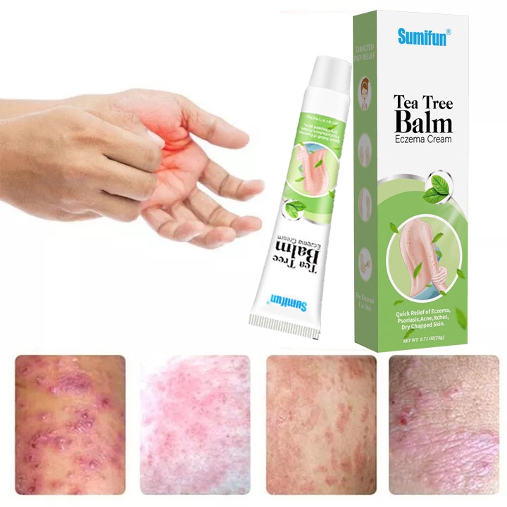 Clobetasol Ointment Eczema Cream Itching Cream Dermatitis Itchy Skin Remedy Psoriasis Antifungal