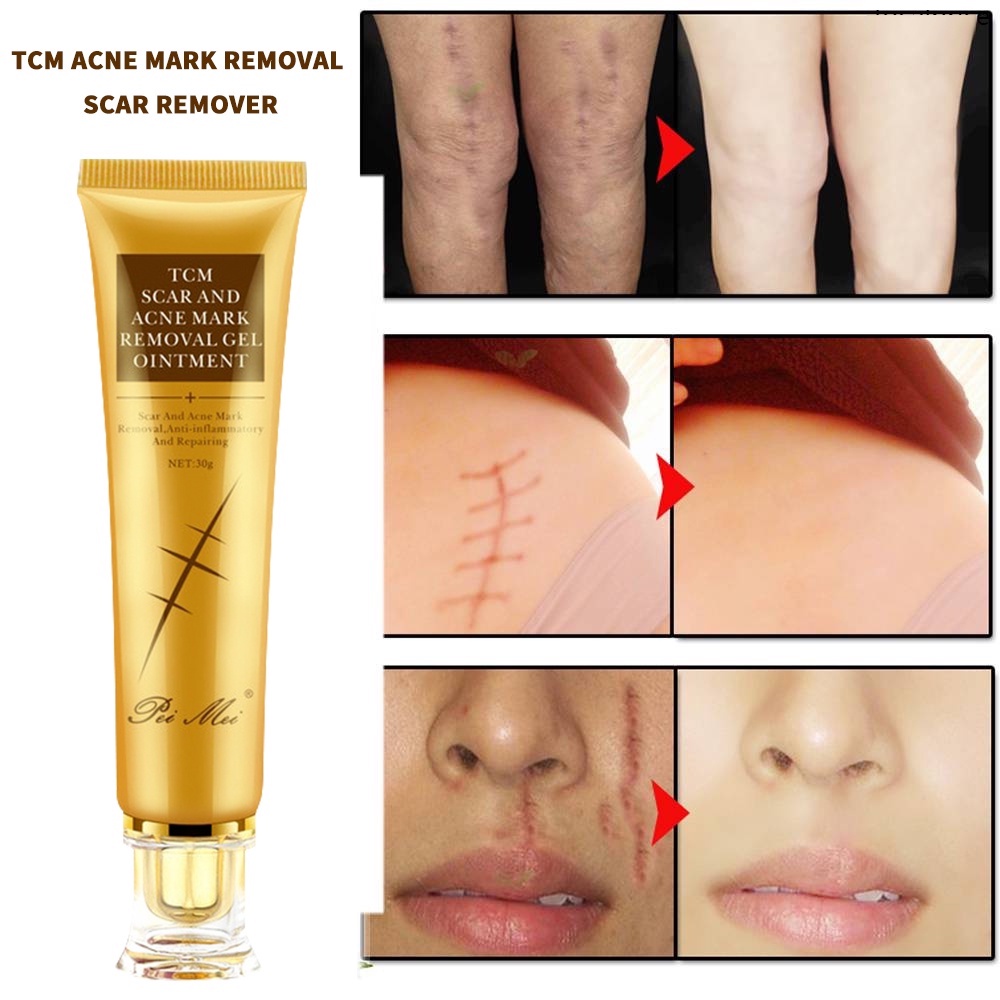 2023 pangtanggal ng peklat scar Removal Cream scne scar remover stretch