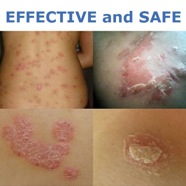 Anti Fungal Treatment Psoriasis Eczema Skin Care Ointment Antimicrobial Salicylic Acid Ringworm