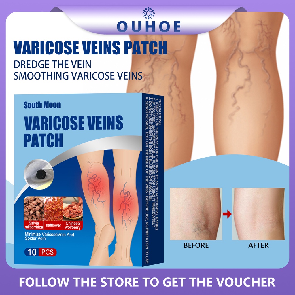 South Moon Varicose Vein Patch,Phlebitis Vasculitis Treat Sticker, Leg ...