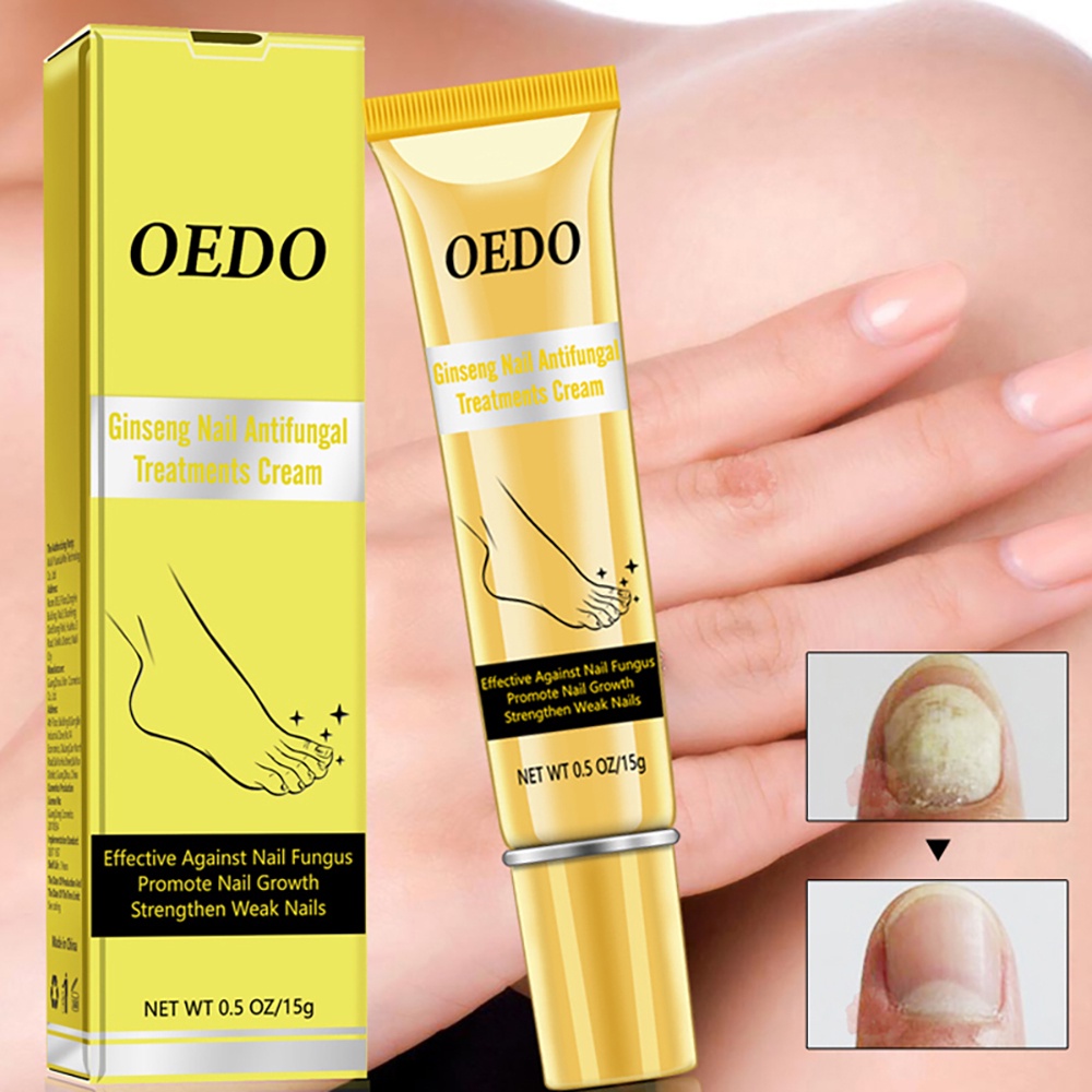 OEDO Ginseng Nail Antifungal Treatments Cream Removal Gel Anti