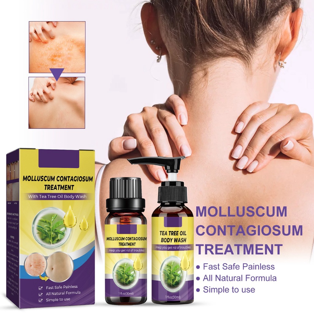 Molluscum Contagiosum Treatment Kit Solution & Tea Tree Oil Body Wash