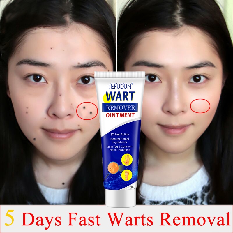 Warts Remover Cream Mole And Warts Remover Warts Magic Remover Wart ...