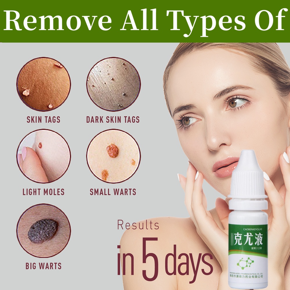 10ml Warts Remover Liquid Remove Foot Corns Mole Skin Tags Get Rid Of Neck Warts Kulugo Wart 1495