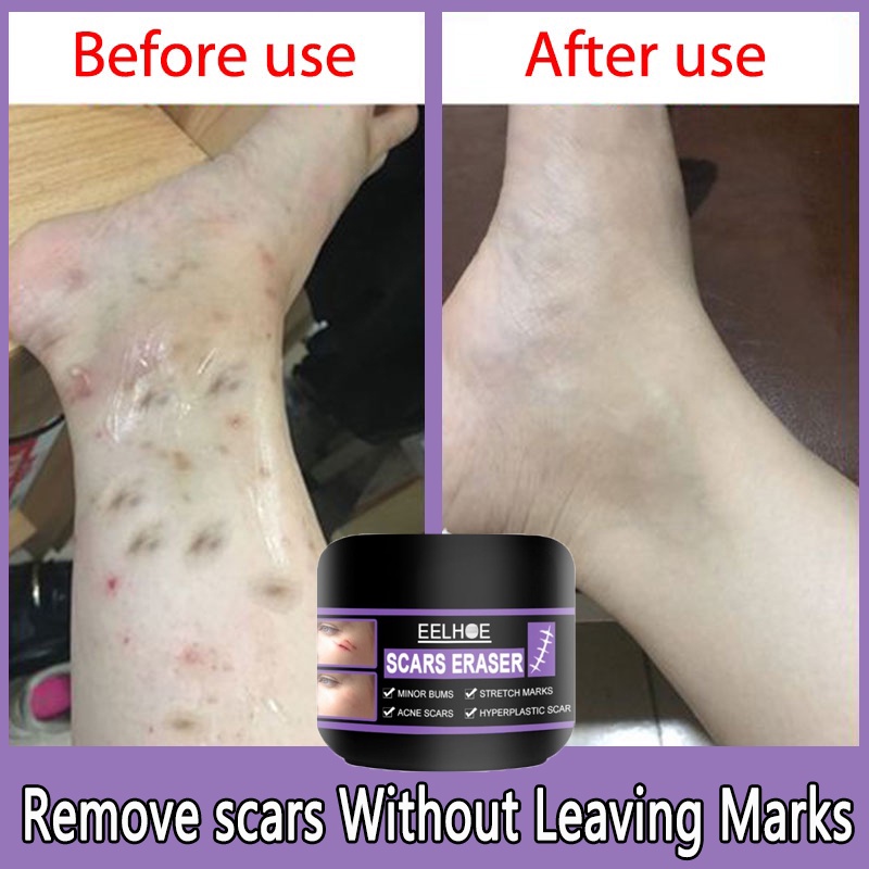 EELHOE 50g Scar Removal Cream Peklat Remover For Old Scars Stretch