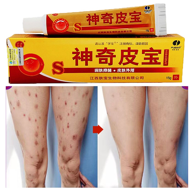 Skin DermatiTis Cream Dermatitis Anti Fungal Infection Psoriasis Eczema