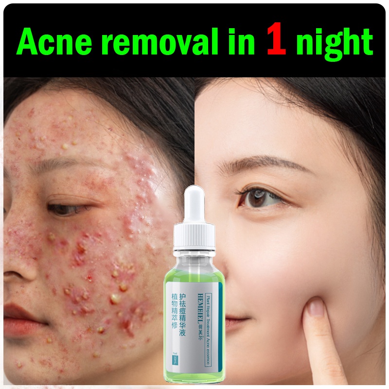 HEMEIEL Acne Treatment Serum | Pimple Remover | Pimple Marks Remover