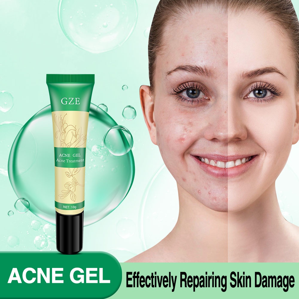 GZE FDA Acne Pimple Spot Gel Treatment For Face/Body/Back Cystic ...