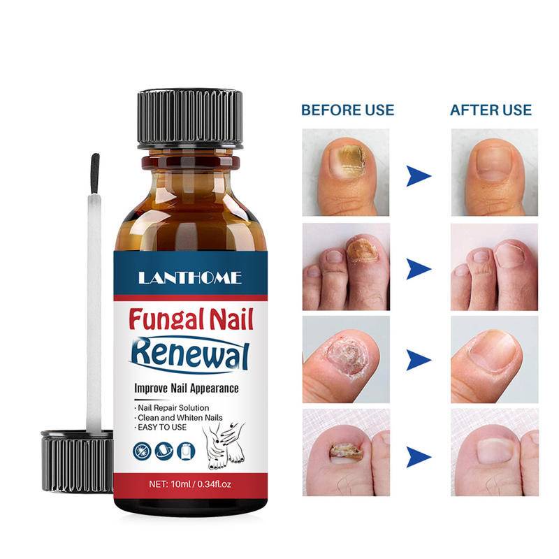 LANTHOME Fungal Nail Serum Nails Fungus Treatment Essence Brush Anti Infection Regenerate Foot