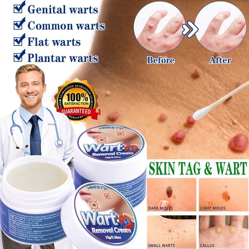 Original fast Warts remover Cream kasoy oil cream Kulugo mole skin tag ...