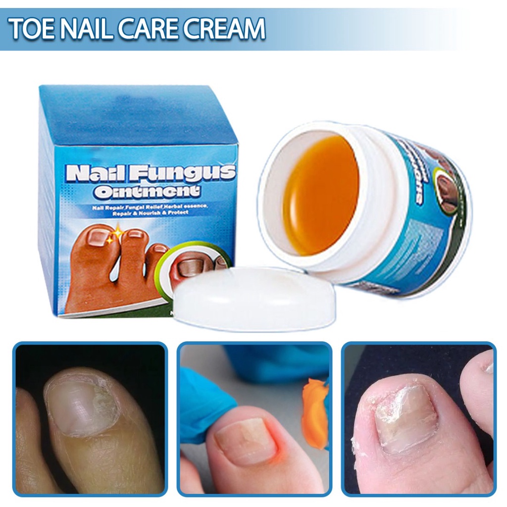 Nail Fungus Ointment Treatment Cream Foot Nail Repair Anti Fungal 20g