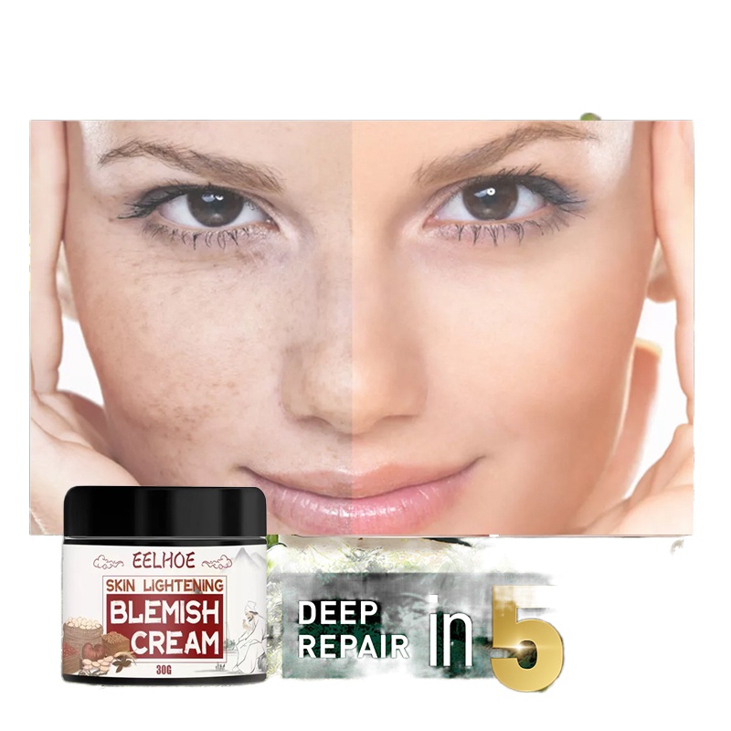 Jekina Melasma Remover Kasumi Abera Melasma Cream Japan Pangea Scar