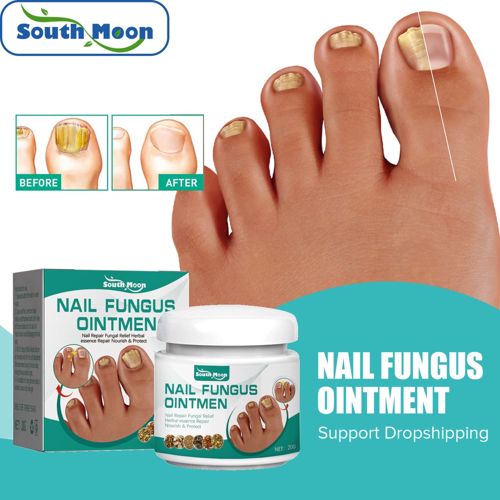 South Moon 20g Nail Fungus Treatment Cream Fast Recovery Onychomycosis 