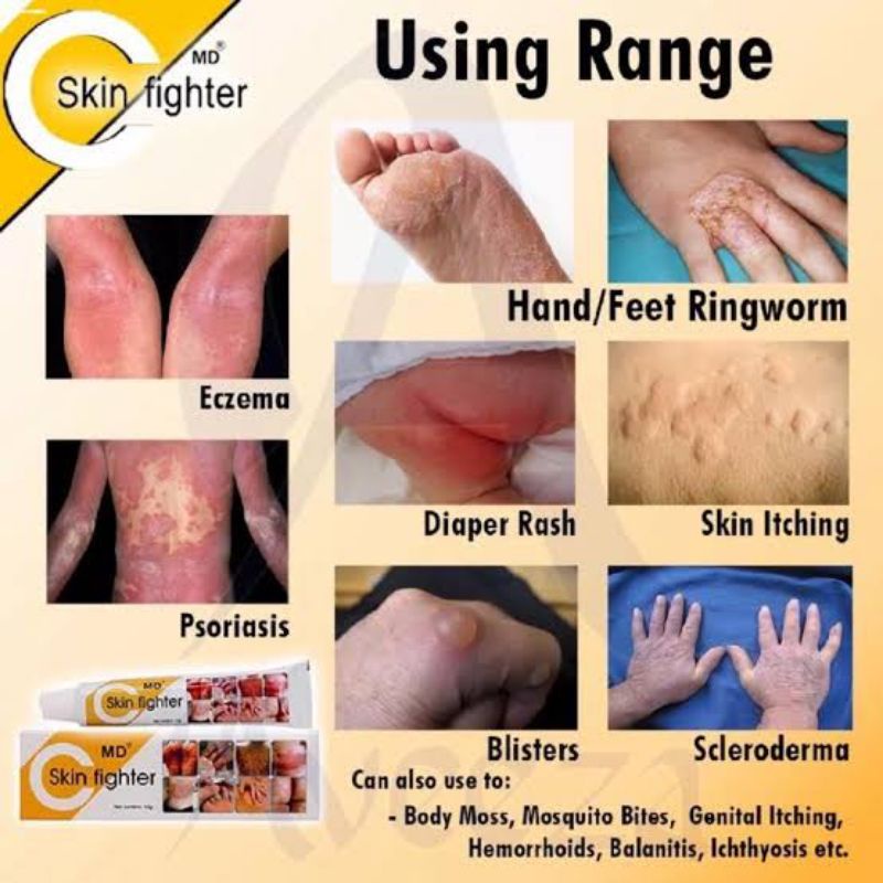 Ointment Ringworm Rashes and blister | Shopee Philippines