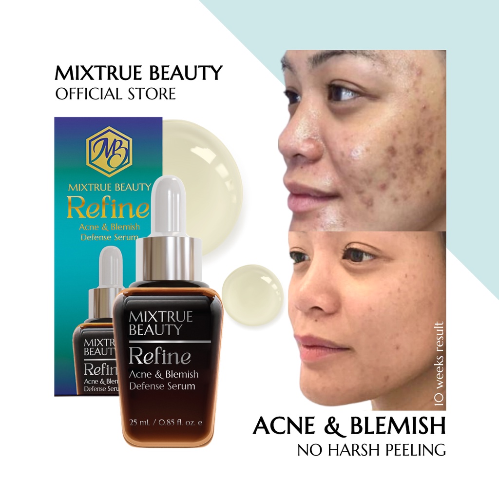 Refine Serum Acne & Blemish Oil Control Shopee Philippines