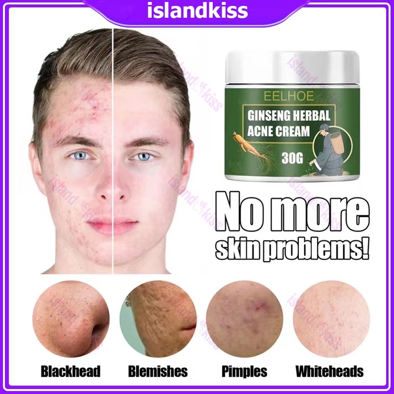 Acne Cream Ginseng Herbal Pimple Remover Acne Marks Remover Skin Care