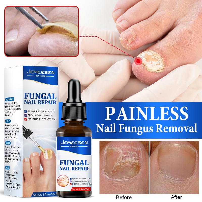 Foot Fungal Treatment Solution, Professional Care Removal Liquid