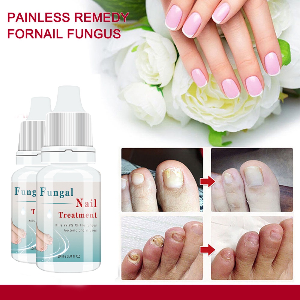 LANTHOME Fungal Liquid Nail Treatment Toenail Fungus Removal Feet Care